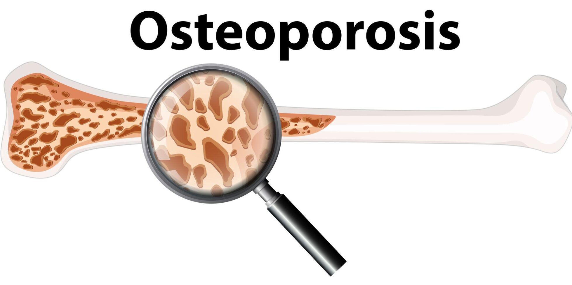 Osteoporosis - Symptoms and Causes